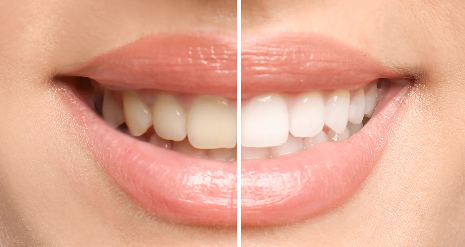 vor und nach der Zahnbehandlung